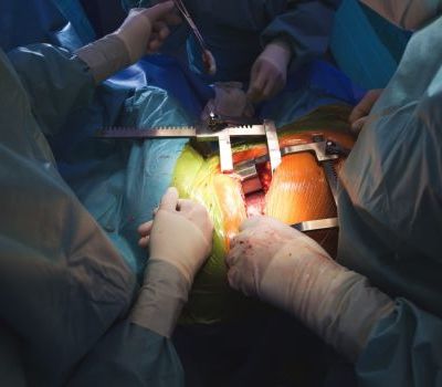 Open-chest surgery